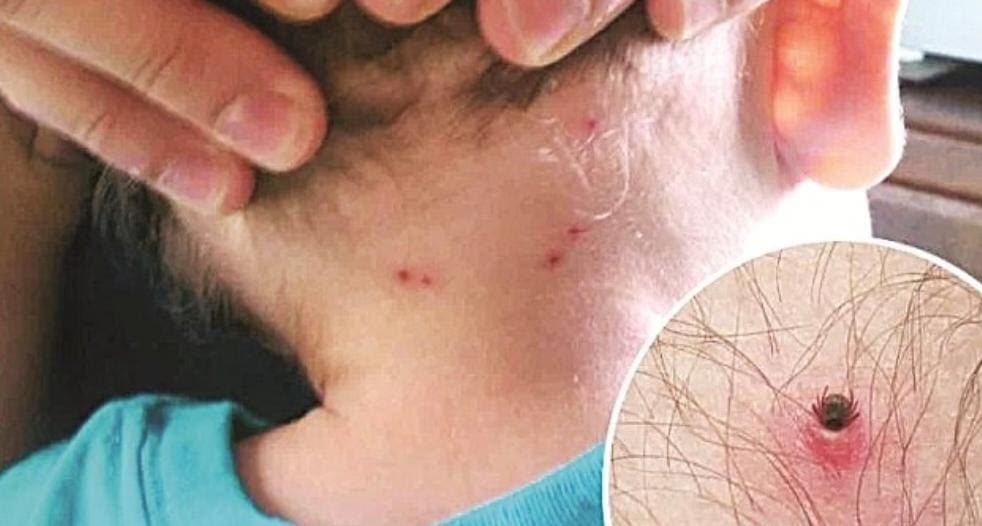 Los niños los mas vulnerables a la Rickettsiosis