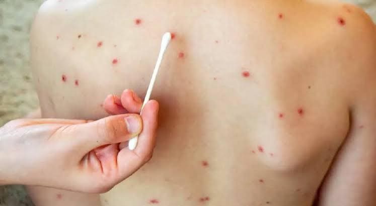 Suman más de 4 mil contagios de sarampión en el estado