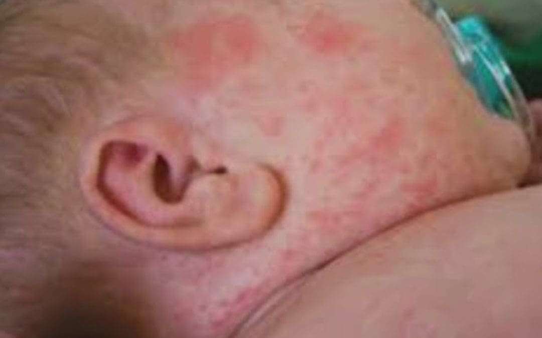 Confirma Salud el deceso número 21 por sarampión; víctima, una bebé