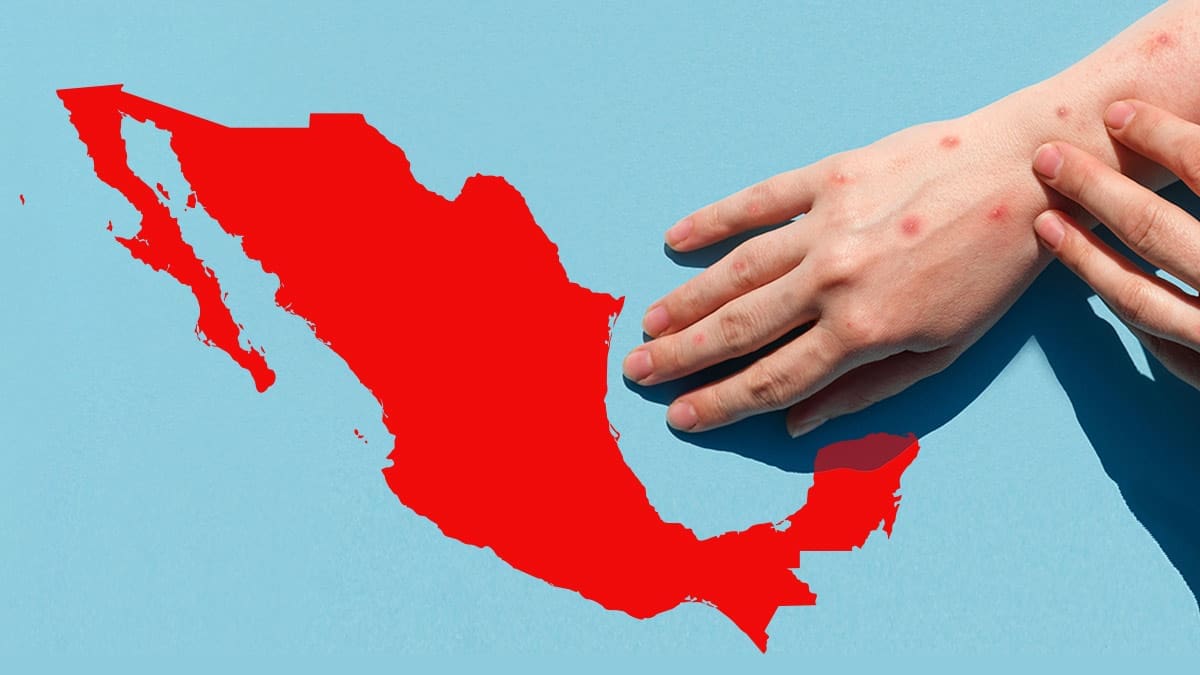 Brote de sarampión deja 21 muertos en México; Chihuahua, el estado más afectado