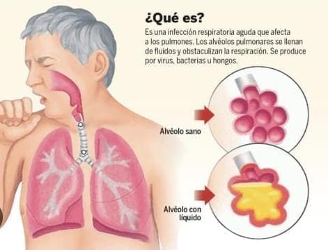 Hay casi 8 mil casos confirmados de Neumonias y Bronconeumonías en la entidad