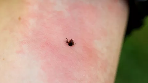 Confirman primera muerte por rickettsiosis en 2026; víctima fue una menor en Chihuahua