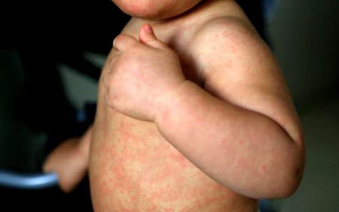 México refuerza vacunación masiva contra el sarampión y toma a Chihuahua como modelo